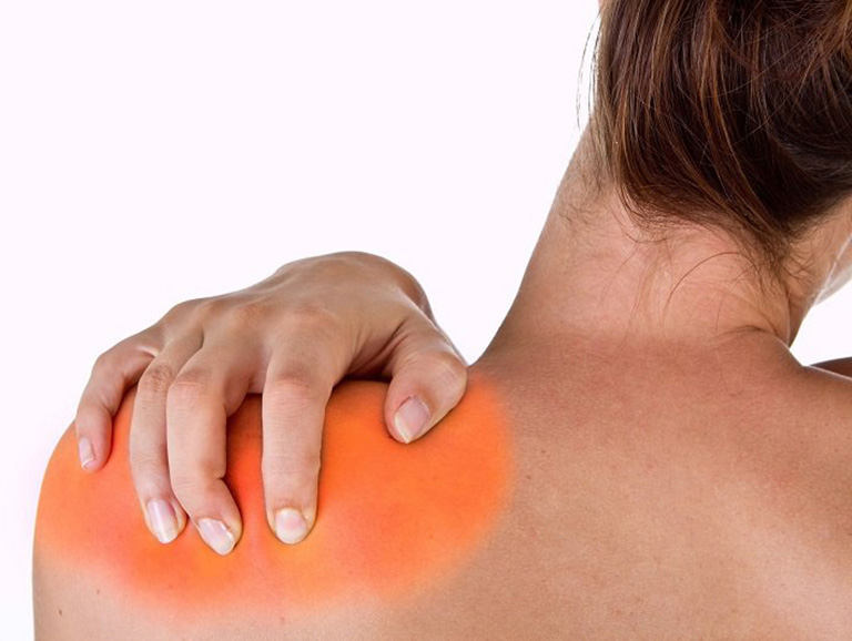 Viêm gân vai vôi hóa - Hình ảnh minh họa